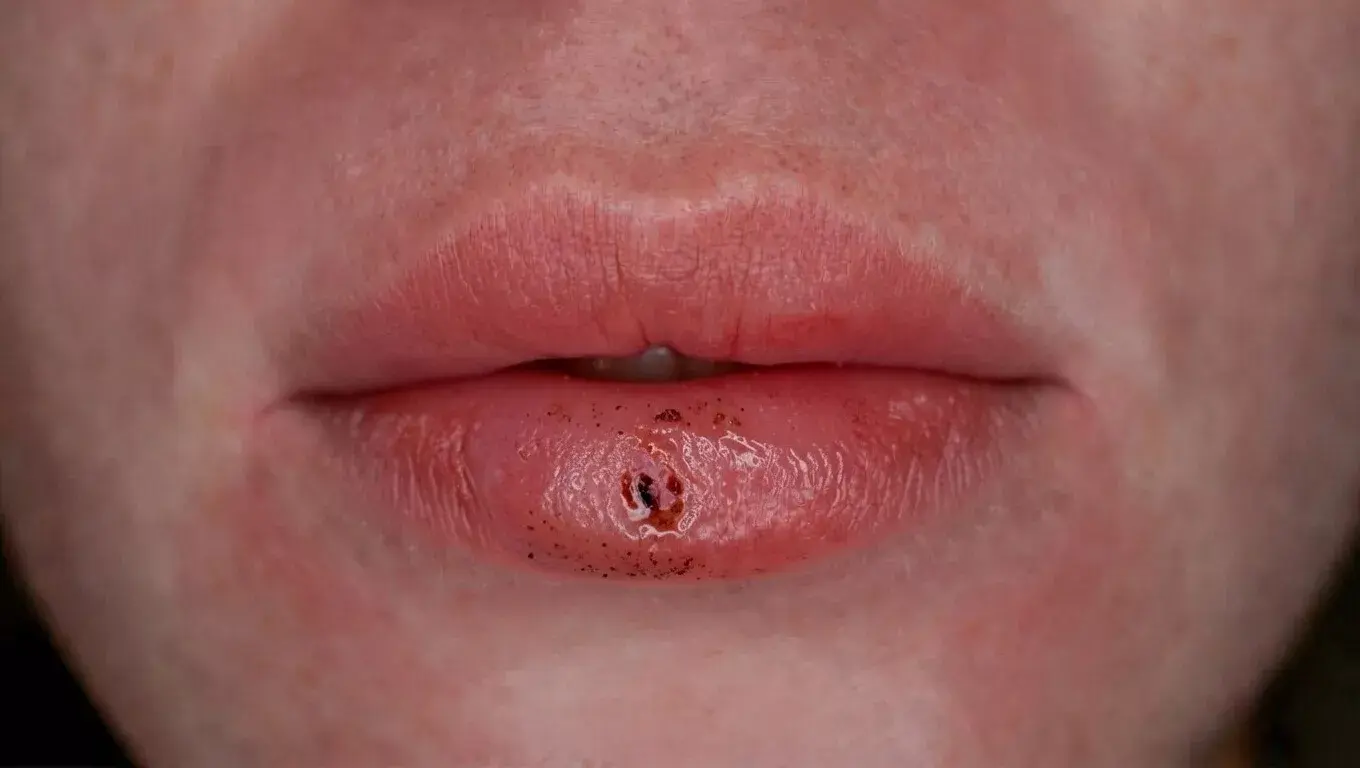 lip damage from overworking pmu